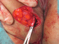 Perianal fistula