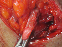 Perianal fistula