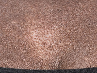 Depigmentatie bij sclerodermie met perifolliculaire pigmentretentie