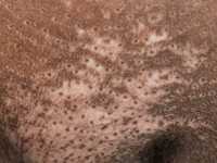 Depigmentatie bij sclerodermie met perifolliculaire pigmentretentie