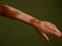 Depigmentatie bij sclerodermie met perifolliculaire pigmentretentie