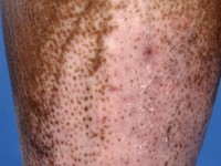 Depigmentatie bij sclerodermie met perifolliculaire pigmentretentie