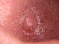 Perifolliculair fibroom