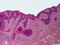 Perifolliculair fibroom