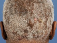 Perifolliculitis capitis abscedens et suffodiens (dissecting folliculitis)