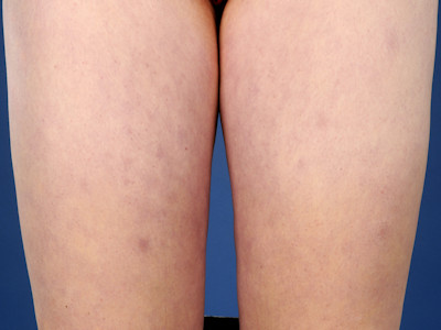 Erythrocyanosis crurum