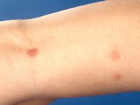 Persistant insectbite