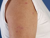 Persistant insectbite