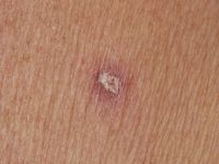 Persistant insectbite