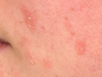 Facial discoid dermatosis