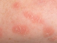 Facial discoid dermatosis