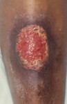 Pyoderma gangrenosum