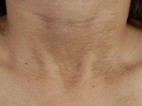 Phaeoderma (terra firma-forme dermatosis)