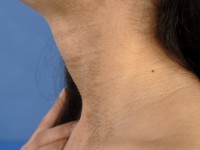 Phaeoderma (terra firma-forme dermatosis)