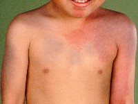 Phakomatosis melanorosea