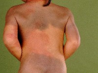 Phakomatosis melanorosea