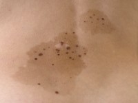 Phakomatosis pigmentokeratotica