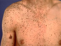 Phakomatosis pigmentovascularis