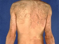 Phakomatosis pigmentovascularis