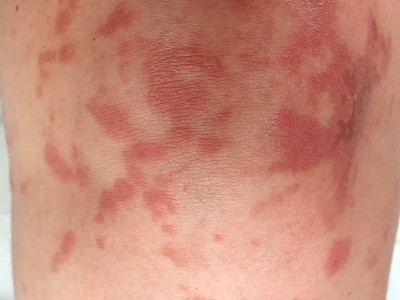 Phytofotodermatitis door de vuurwerkplant (Dictamnus albus)