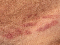 Poison Ivy dermatitis (USA)