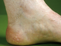 Piezogenic papules