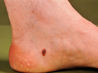 Piezogenic papules