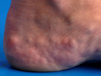 Piezogenic papules