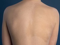 Segmentale hyperpigmentatie