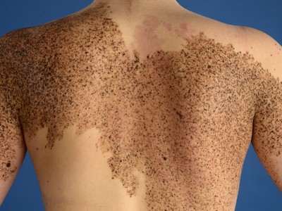 Phakomatosis spilorosea