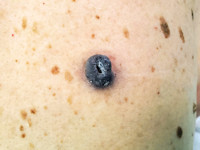 Pigmented epithelioid melanocytoma