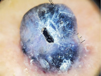 Pigmented epithelioid melanocytoma