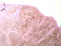 Pigmented epithelioid melanocytoma