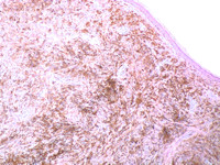 Pigmented epithelioid melanocytoma
