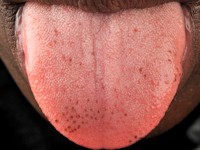 Pigmented fungiform lingual papillae