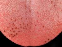 Pigmented fungiform lingual papillae