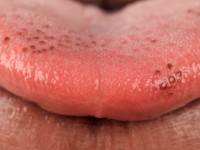 Pigmented fungiform lingual papillae