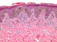 Naevus van Reed (gepigmenteerde spoelcel naevus)