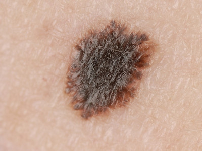 Naevus van Reed (gepigmenteerde spoelcel naevus)