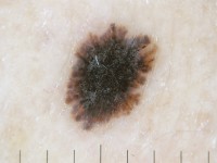 Dermatoscopie naevus van Reed, starburst pattern