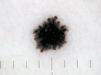 Naevus van Reed (gepigmenteerde spoelcel naevus)