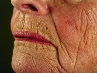 Pilar sheet acanthoma