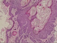 Pilar sheet acanthoma