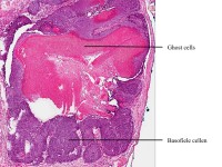 Pilomatrixoma