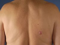 Fibroepithelioma (Pinkus tumor)