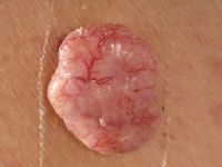 Fibroepithelioma (Pinkus tumor)