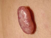Fibroepithelioma (Pinkus tumor)