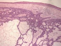 Fibroepithelioma (Pinkus tumor)