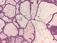 Fibroepithelioma (Pinkus tumor)