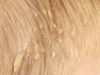 Pityriasis amianthiacea